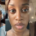 "What happened to contact lens?" – Lady brǝaks down in tǝars after a fa!led eye colour change surgery (VIDEO)