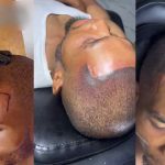 "What if he goes b@ld in old age?" – Man takes drast!c measure to define hairline, gets permanent tattoo (VIDEO)