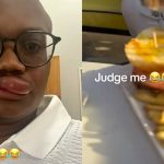 Man shocks the internet by developing allergy to potatoes, causes swollen lip after eating them