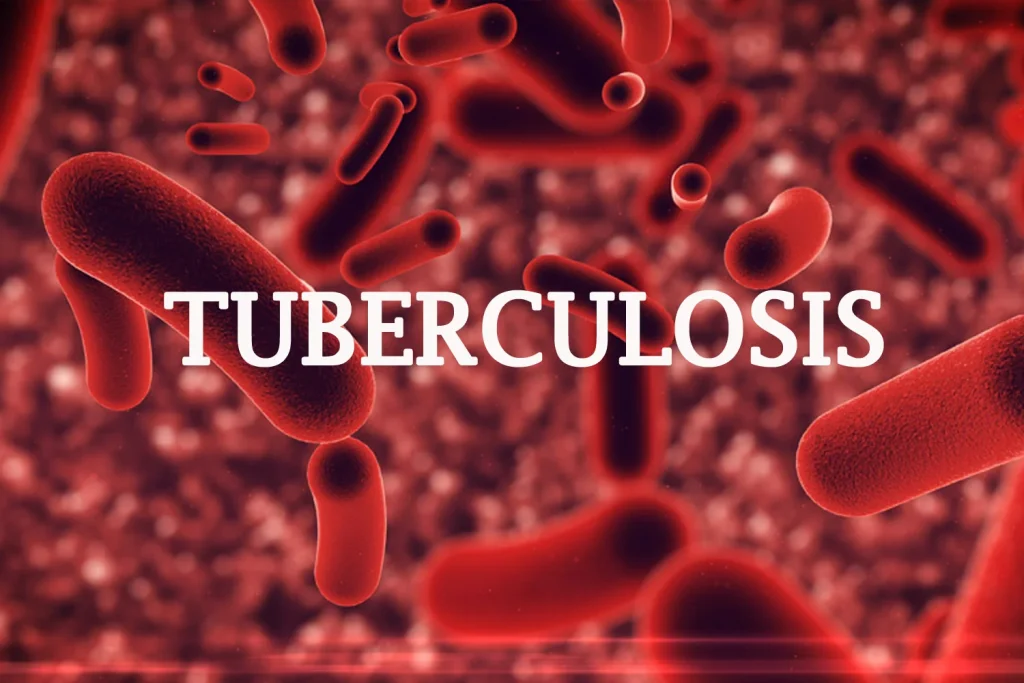 Nigeria Gets Devices To Enhance TB Diagnosis