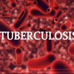 Nigeria Gets Devices To Enhance TB Diagnosis